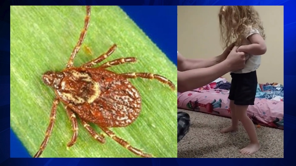 Tick bite temporarily paralyzes 3yearold WSVN 7News Miami News