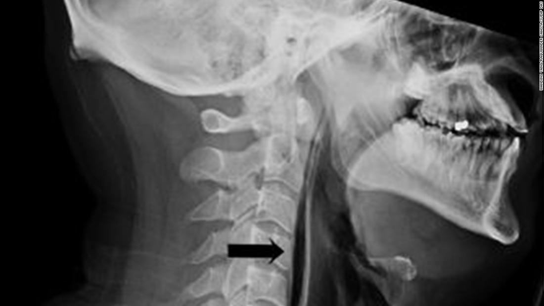 Doctors Say A Man Who Held In A Sneeze Blew A Hole In His Throat Wsvn 7news Miami News Weather Sports Fort Lauderdale