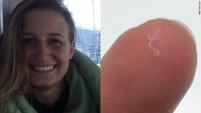 I Looked At It And It Was Moving Woman Pulls 14 Worms From Her Eye Wsvn 7news Miami News Weather Sports Fort Lauderdale