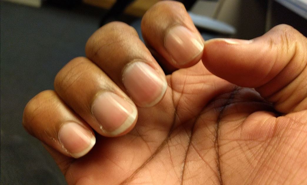 Man Nearly Dies From Sepsis Due To Biting His Fingernails Wsvn 7news Miami News Weather Sports Fort Lauderdale Man Nearly Dies From Sepsis Due To Biting His Fingernails Wsvn 7news Miami News Weather Sports Fort Lauderdale