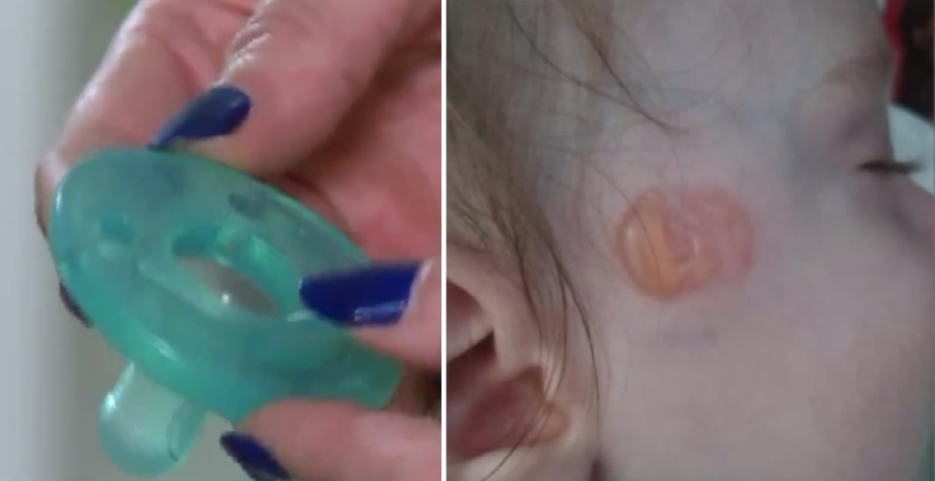 Mother warns parents after pacifier burns infant WSVN 7News Miami