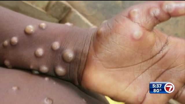 Monkeypox Outbreak Information - Valley-Wide Health