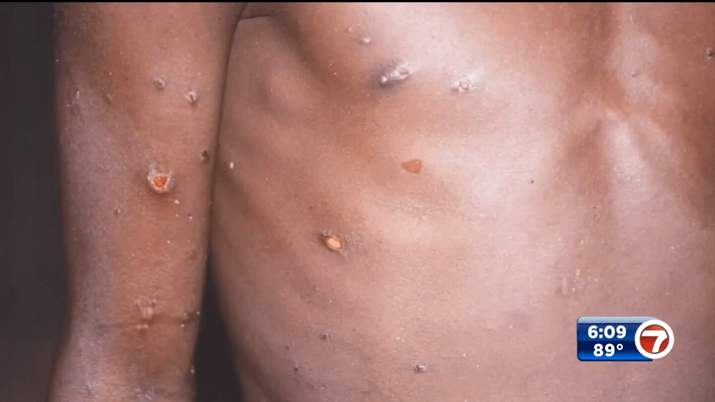 Over 166 cases of monkeypox reported in South Florida – WSVN 7News | Miami News, Weather, Sports