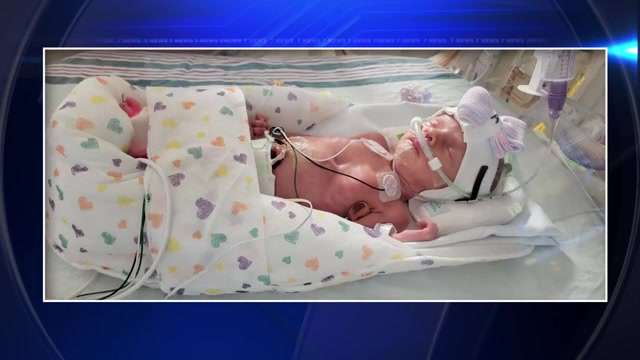 Woman gives birth to 1st quadruplets delivered at HCA Florida Mercy Hospital - WSVN 7News | Miami News, Weather, Sports - Vimarsana News