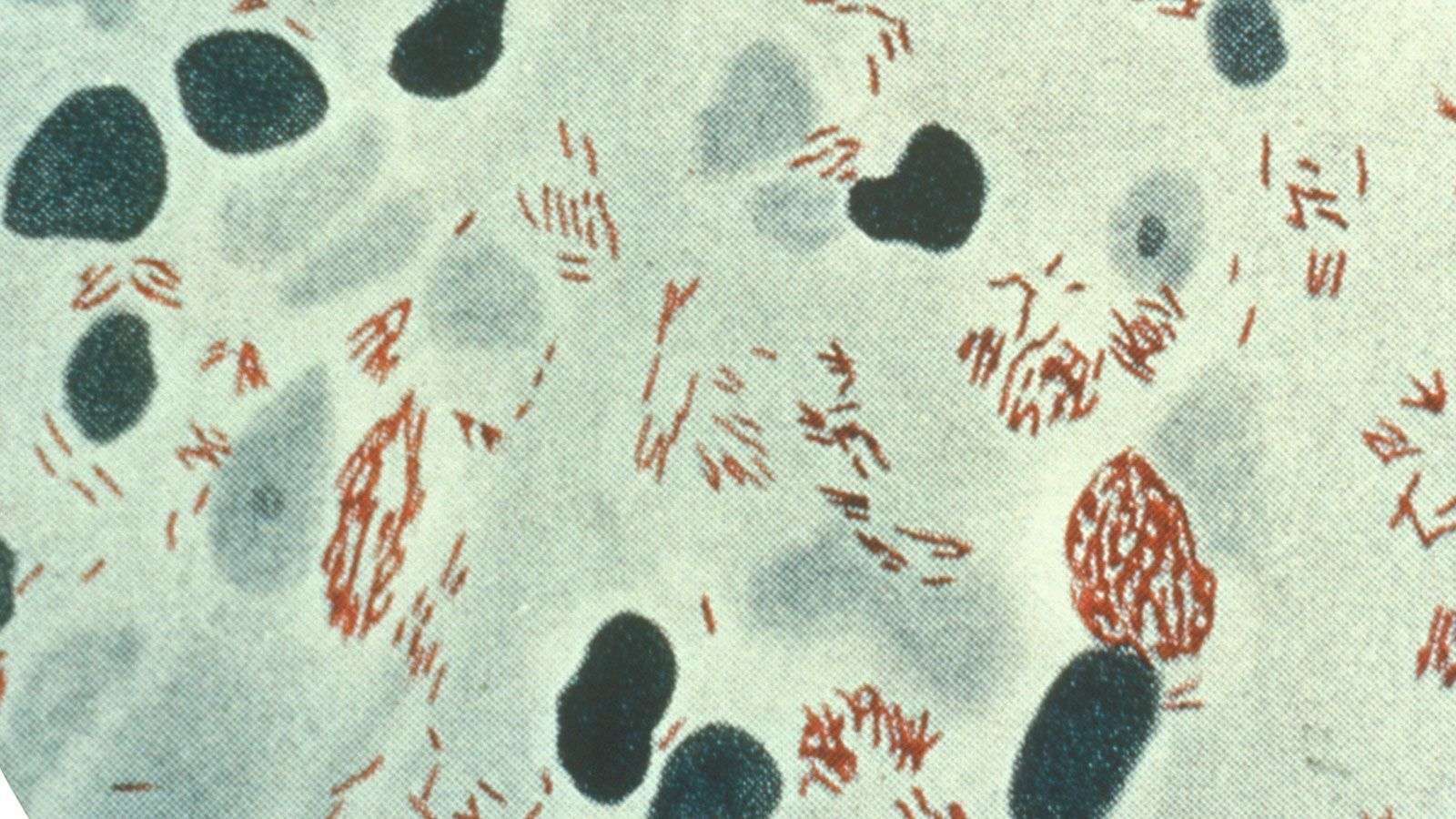Central Florida is a hot spot for leprosy, report says - WSVN 7News | Miami News, Weather, Sports - Vimarsana News