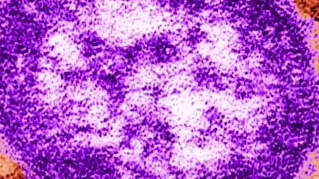 Health officials say passenger with measles flew from Boston to Miami