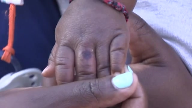 Mother believes baby’s hand was burned at NE Miami-Dade day care; facility’s owner says infant was injured elsewhere – WSVN 7News | Miami News, Weather, Sports