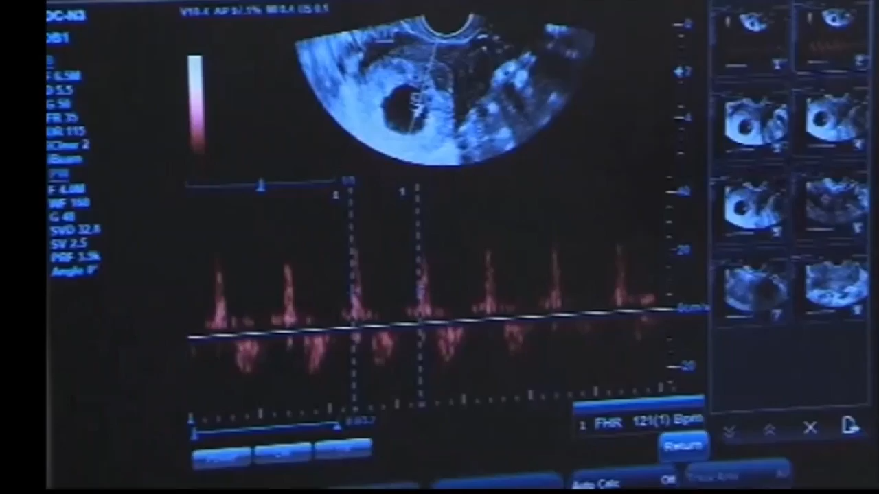 Arizona lawmakers vote to undo neartotal abortion ban from 1864, with
