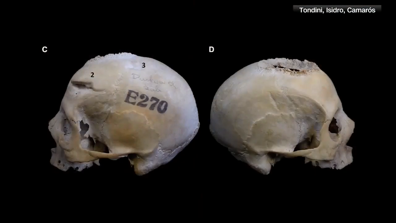 Evidence of surgical tumor removal in ancient Egyptian skull is ...