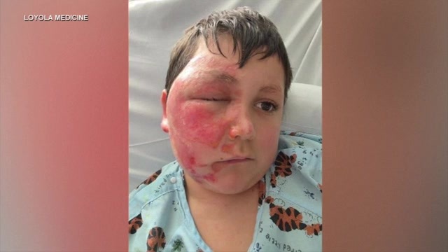 Chicago-area mother warns of TikTok trend involving Needoh cubes that left 9-year-old son with severe burns