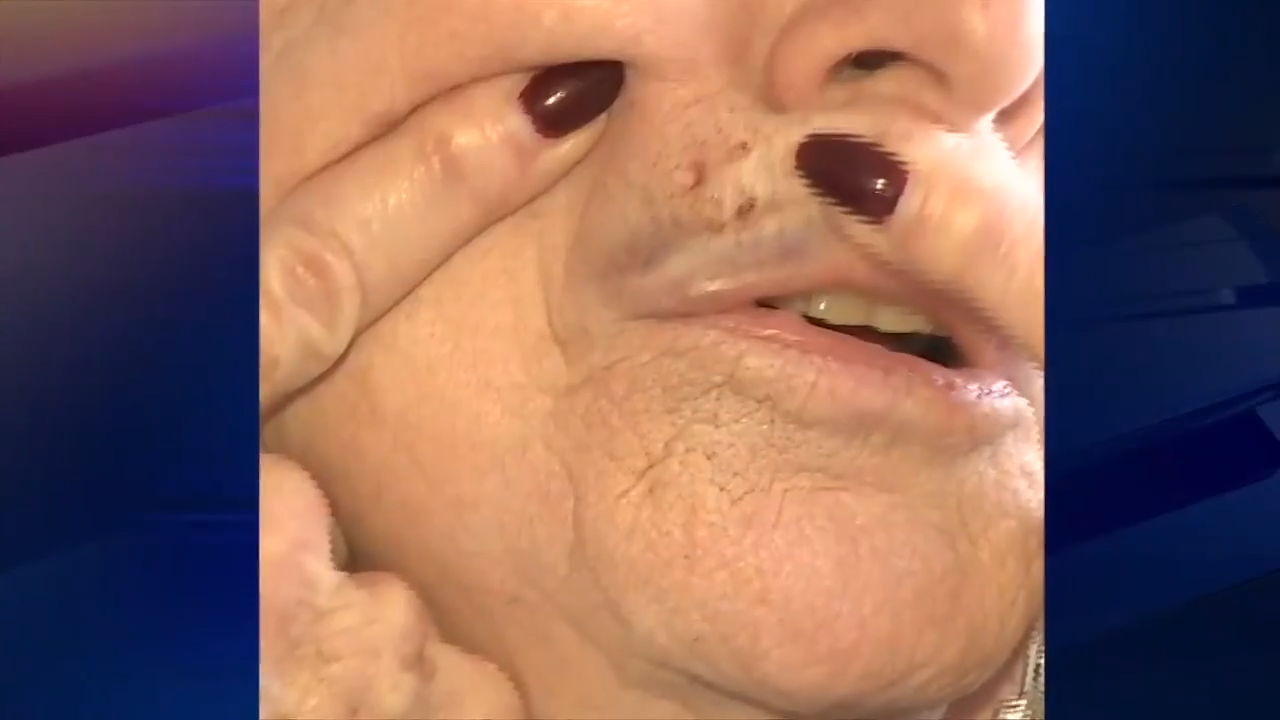 wsvn.com - Matthew Garcia - 'She just clobbered me': Elderly woman suffers busted lip after being attacked in Miami Beach - WSVN 7News | Miami News, Weather, Sports | Fort Lauderdale