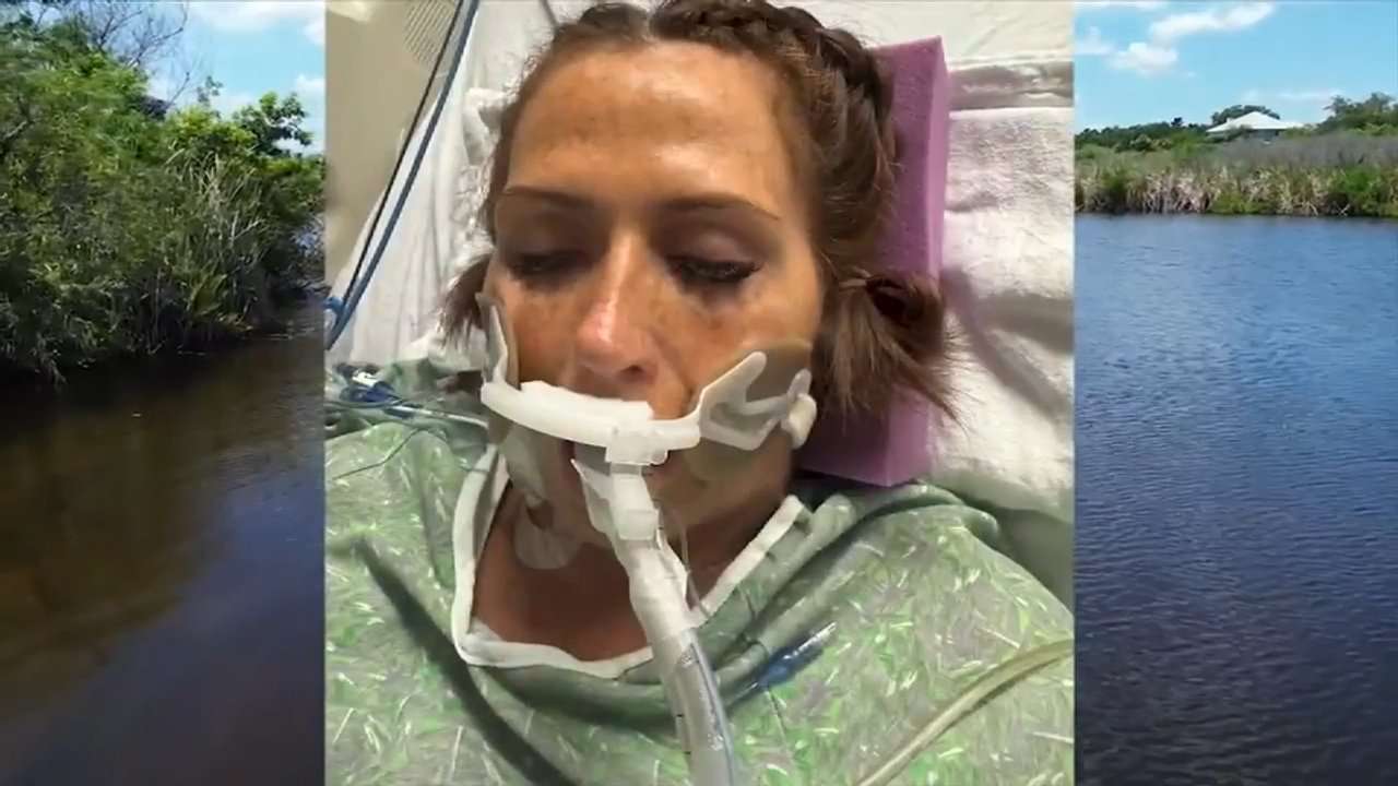 Florida woman says she’s lucky to be alive after recovering from flesh-eating bacteria