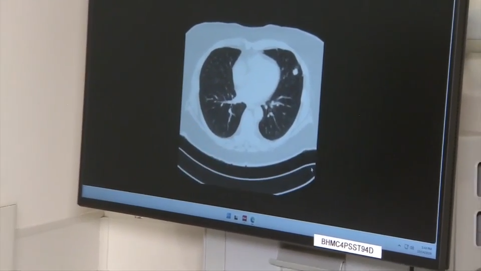 Pope Leo XIV has lung cancer called adenocarcinoma. Here’s what that means